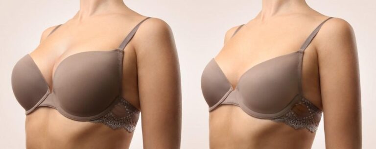 Bra For Breast Implants - Breast Reduction