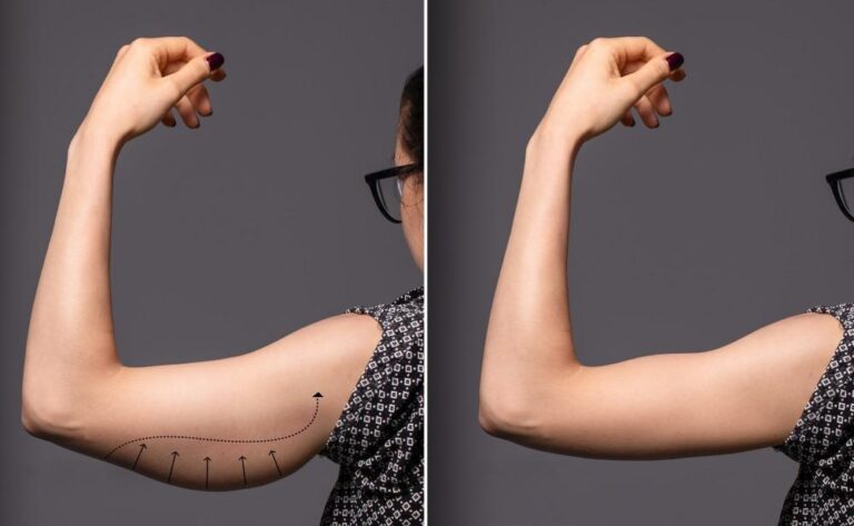 Flabby Arms? What To Do!