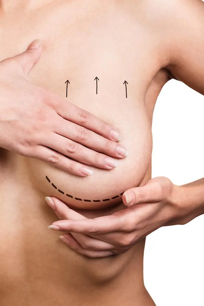 Options for Droopy Breasts – Breast Lift, Implants or Both