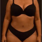 Tummy Tuck After Photo
