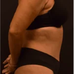 Tummy Tuck After Photo