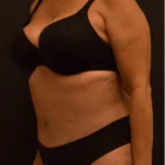 Tummy Tuck After Photo