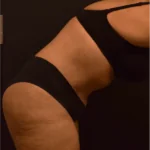 Tummy Tuck After Photo