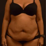 Tummy Tuck Before Photo