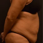 Tummy Tuck Before Photo