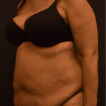 Tummy Tuck Before Photo