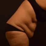 Tummy Tuck Before Photo