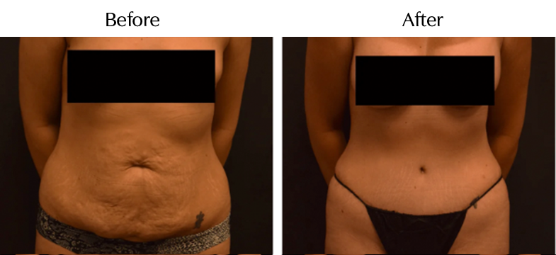 Abdominoplasty Tummy Tuck, Dallas Fort Worth