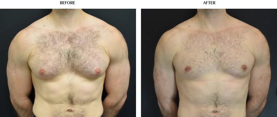 Breast Reduction for Men