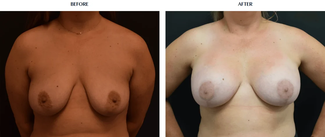Breast Lift