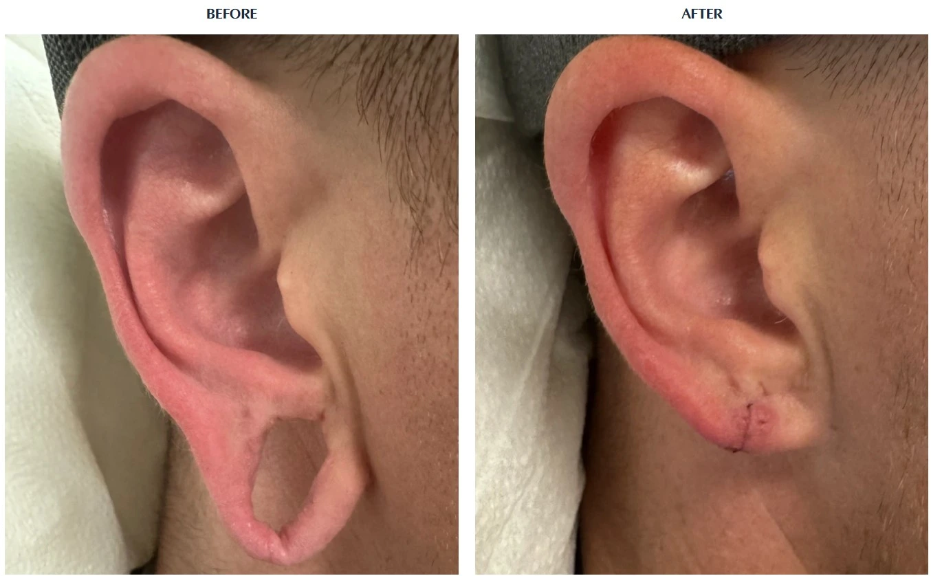 ear gauge repair before and after photos