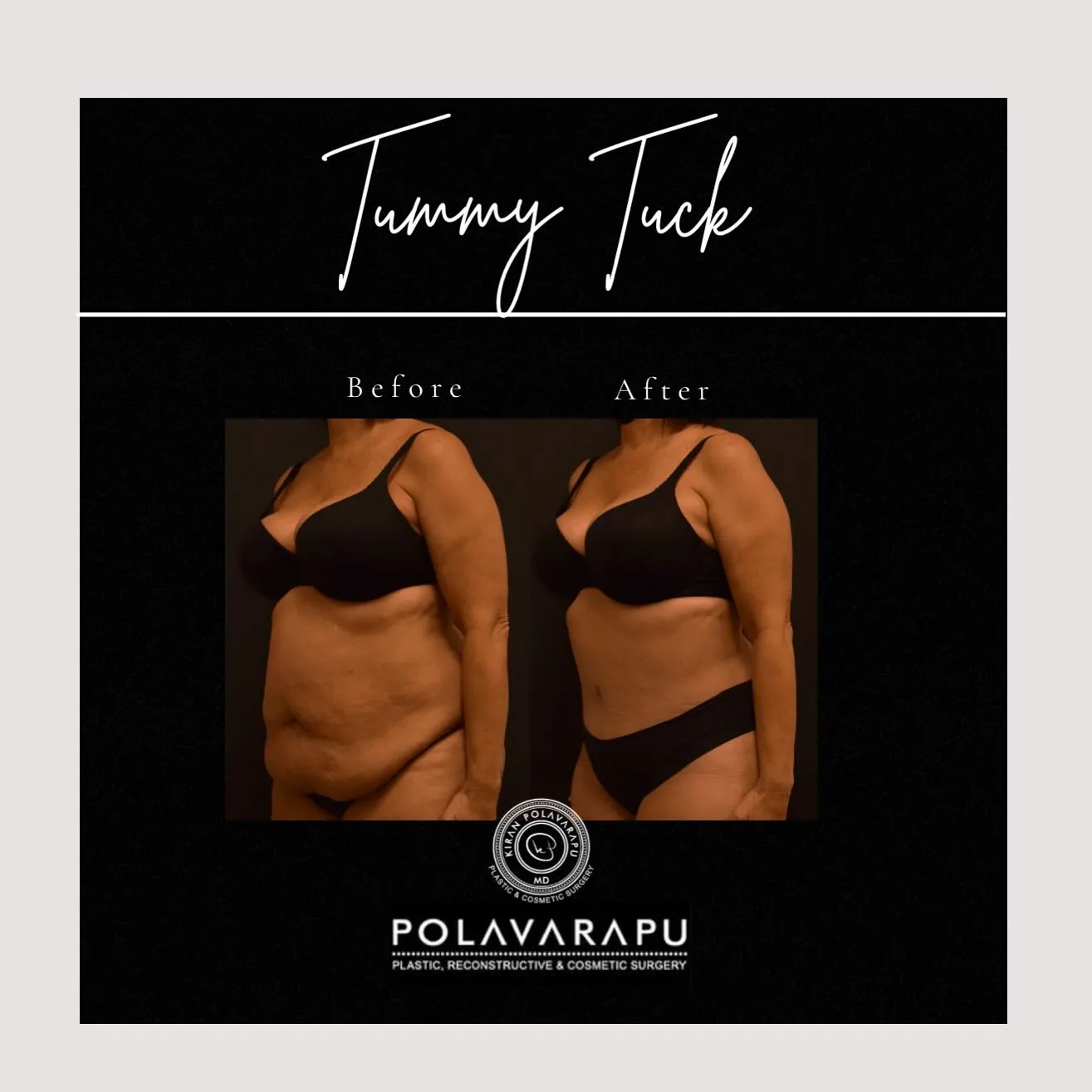 tummy tuck patient before and after photos 3 quarter view